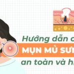 Hướng dẫn cách trị mụn mủ sưng to an toàn và hiệu quả