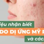 Dấu hiệu nhận biết mụn do dị ứng mỹ phẩm và cách xử lý