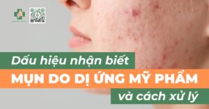 dấu hiệu nhận biết mụn do dị ứng mỹ phẩm và cách xử lý