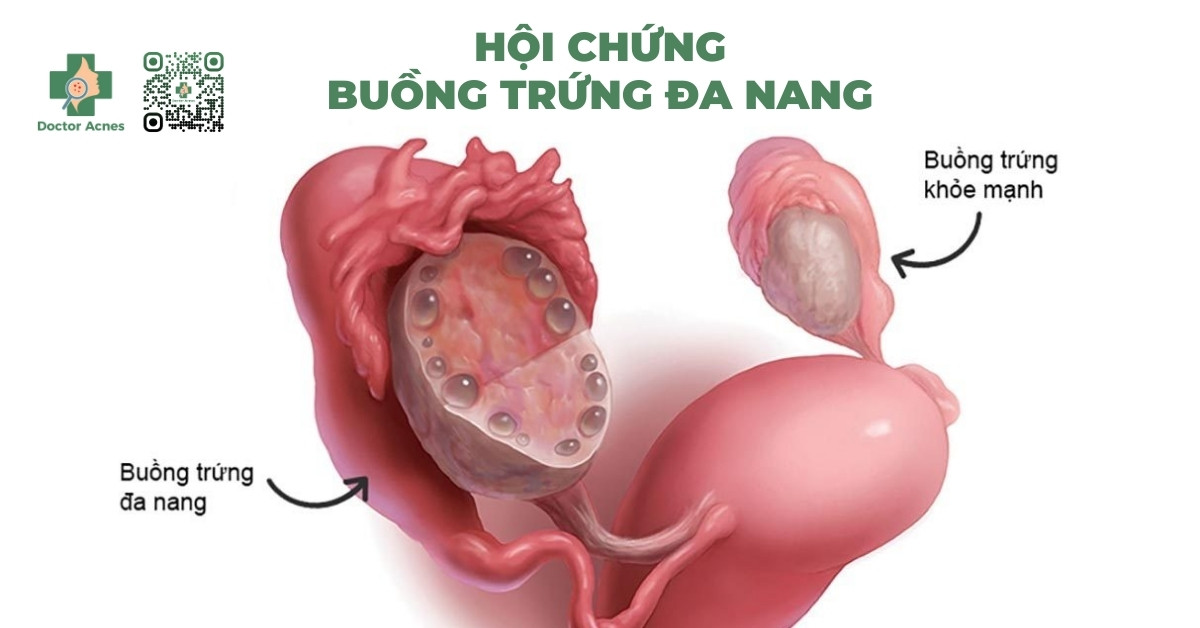 hội chứng buồng trứng đa nang