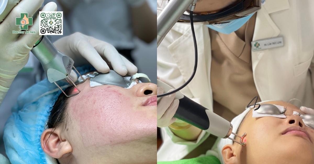 laser trị sẹo