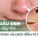 Mụn đầu đen tuổi dậy thì: nguyên nhân và cách điều trị hiệu quả
