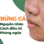Mụn trứng cá: nguyên nhân, cách điều trị và phòng ngừa mụn