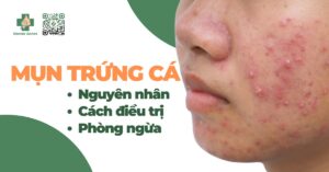 mụn trứng cá