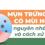 Mụn trứng cá có mùi hôi: nguyên nhân và cách xử lý
