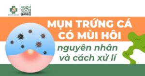 mụn trứng cá có mùi hôi