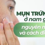 Mụn trứng cá ở nam giới: nguyên nhân và cách điều trị