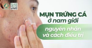 mụn trứng cá ở nam giới