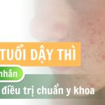 Mụn tuổi dậy thì – Nguyên nhân và cách điều trị chuẩn y khoa