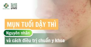 mụn tuổi dậy thì