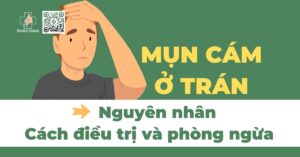 nguyên nhân gây mụn cám