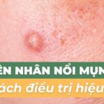 Nguyên nhân nổi mụn ở má và cách điều trị hiệu quả