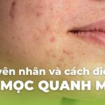 Nguyên nhân và cách điều trị mụn mọc quanh miệng
