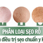 Phân loại sẹo rỗ và cách điều trị sẹo chuẩn y khoa