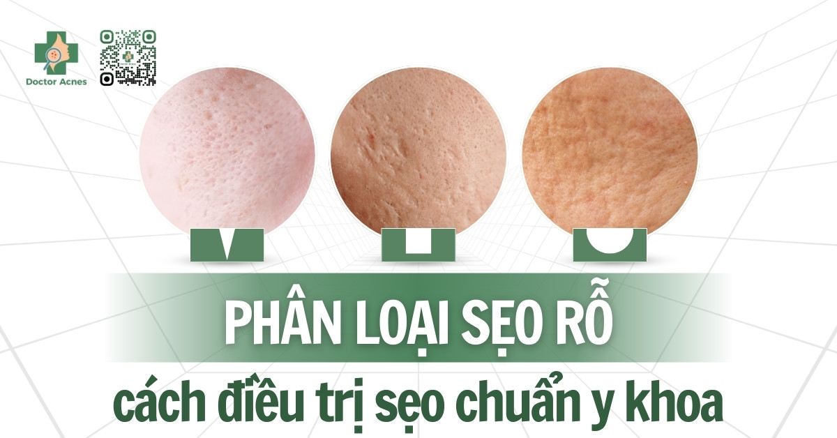 phân loại sẹo rỗ