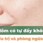 Sẹo lõm có tự đầy không? Cách điều trị và phòng ngừa sẹo lõm