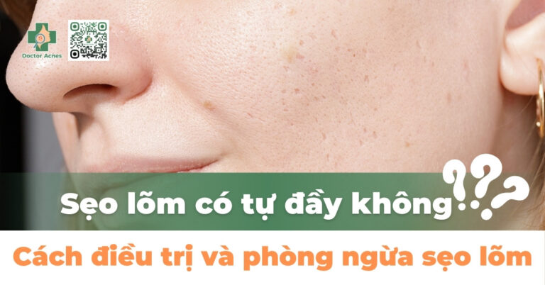 Sẹo lõm có tự đầy được không