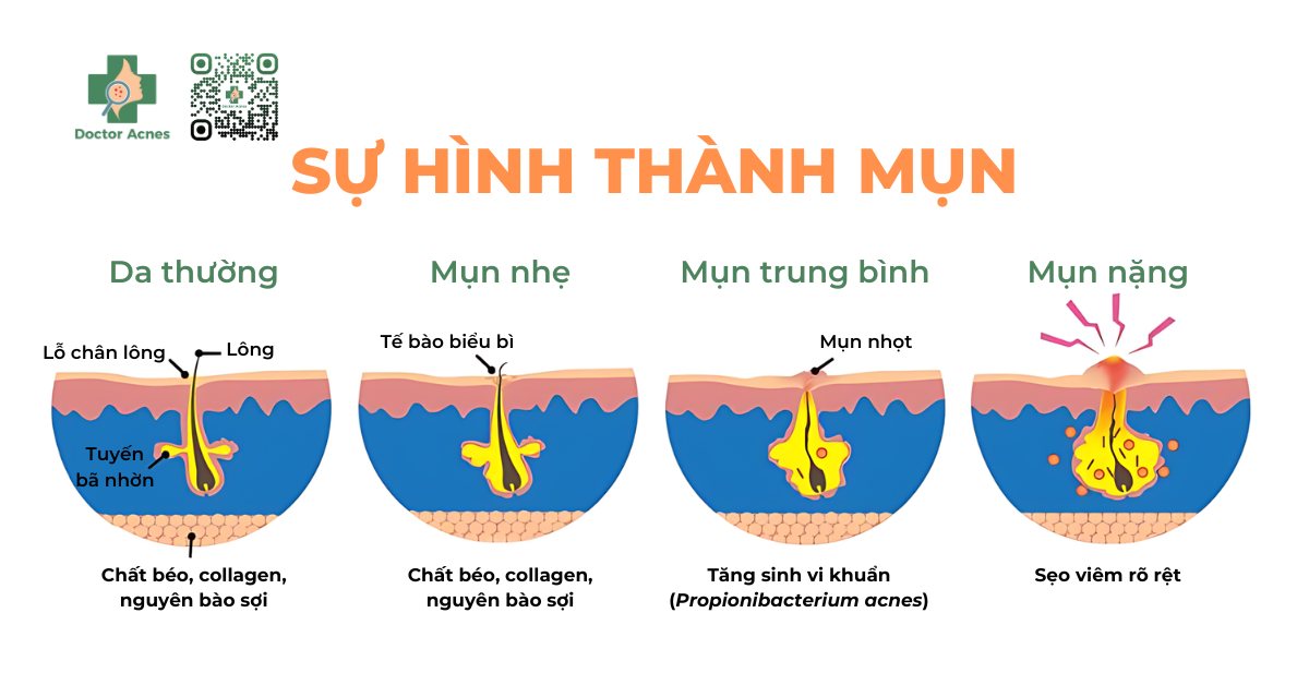 sự hình thành mụn