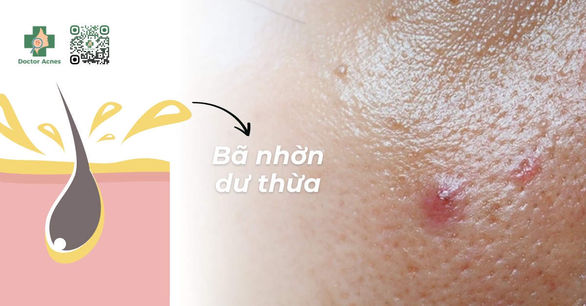 bã nhờn gây tắc lỗ chân lông