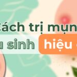 Mẹ bầu bị mụn sinh xong có hết không? Cách trị mụn sau sinh hiệu quả