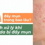 BHA đẩy mụn trong bao lâu? Cách xử lý khi làn da bị đẩy mụn