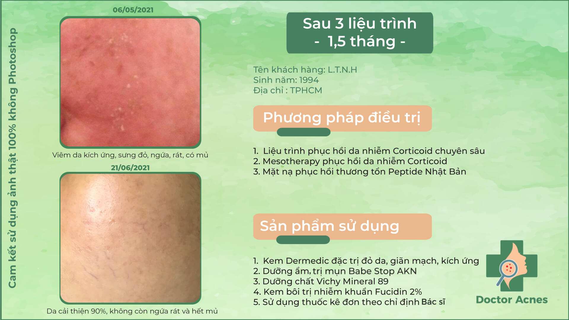 ca lâm sàng điều trị da nhiễm corticoid