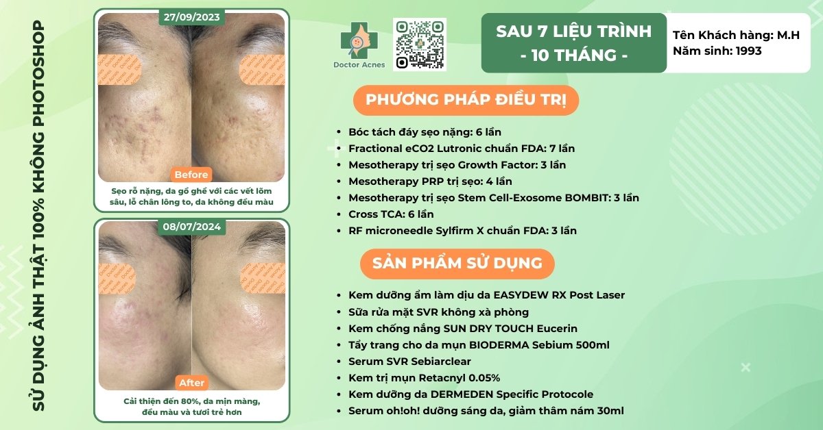 ca lâm sàng điều trị sẹo rỗ có sử dụng laser