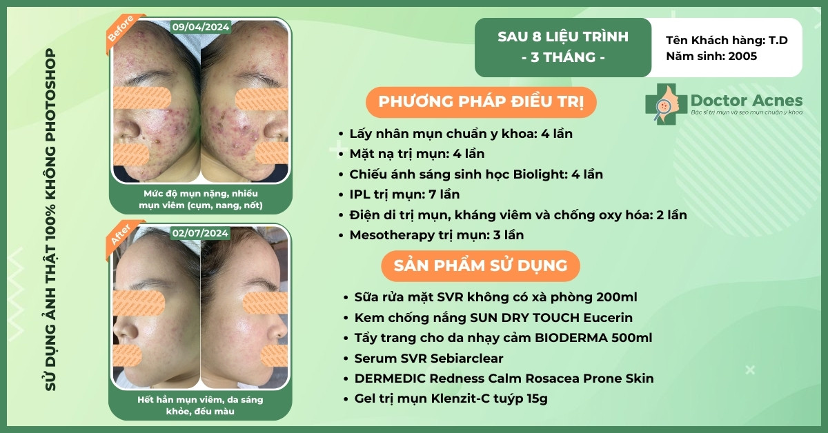 ca lâm sàng trị mụn