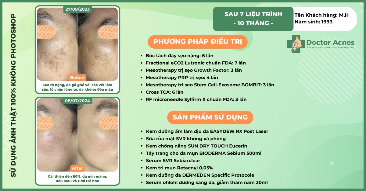 ca lâm sàng trị sẹo