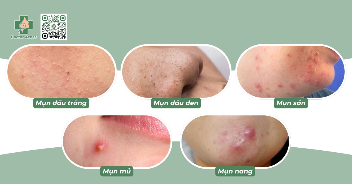 các loại mụn thường gặp