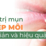 Cách trị mụn ở mép môi đơn giản và hiệu quả