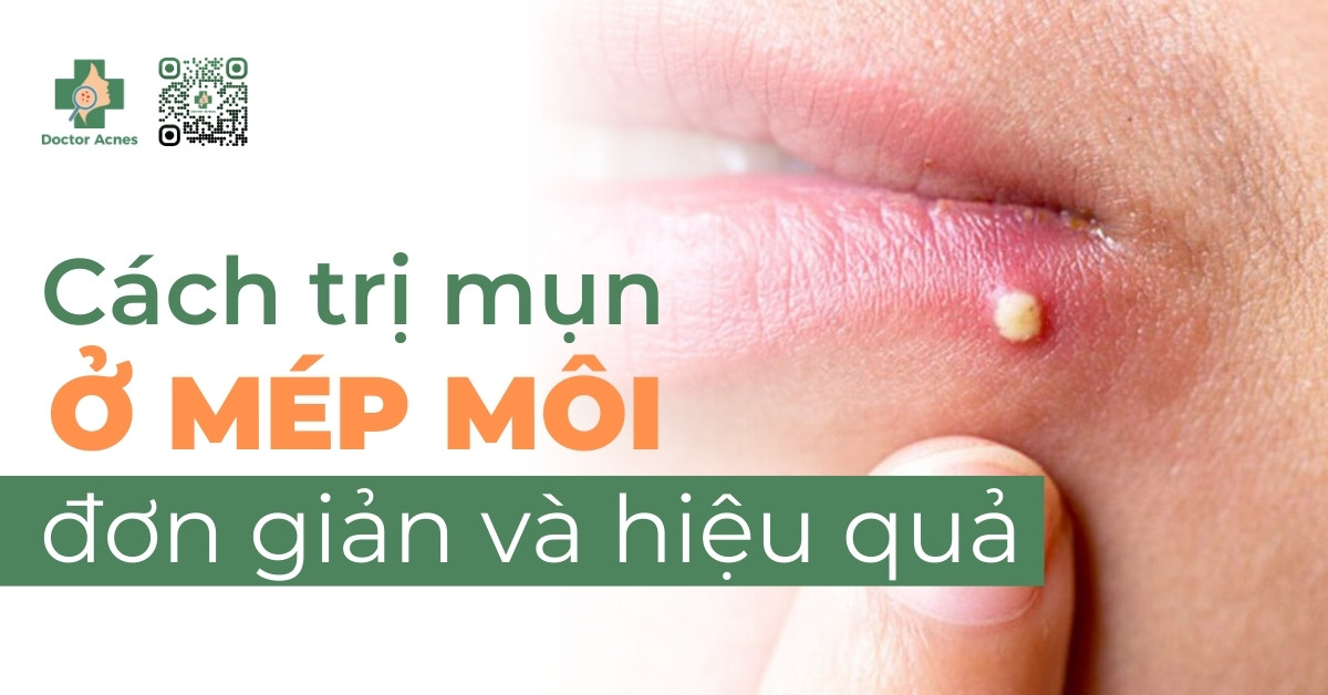 NỔI MỤN NƯỚC TRONG SUỐT Ở MÉP MÔI DO HERPES GÂY RA