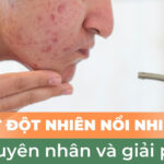 Da mặt đột nhiên nổi nhiều mụn: nguyên nhân và giải pháp