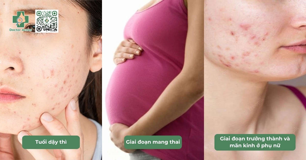 giai đoạn dễ bị mụn nội tiết