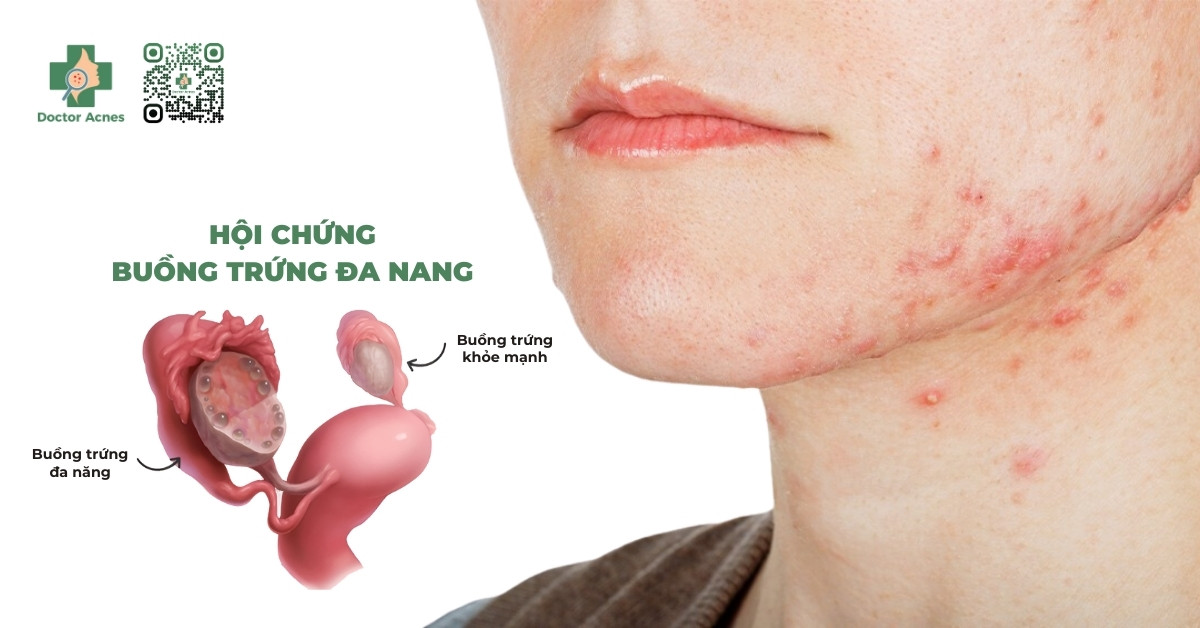 hội chứng pcos