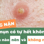 Không nặn mụn có tự hết không? Loại mụn nào nên và không nên nặn?