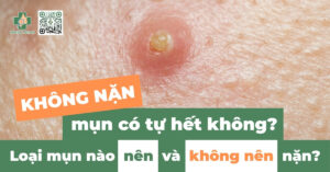 không nặn mụn mụn có tự hết