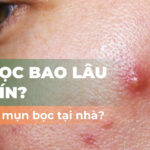Mụn bọc bao lâu thì chín? Có nên trị mụn bọc tại nhà?