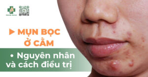 mụn bọc ở cằm