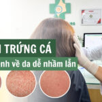 5 bệnh về da dễ nhầm lẫn với mụn trứng cá