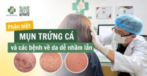 phân biệt mụn