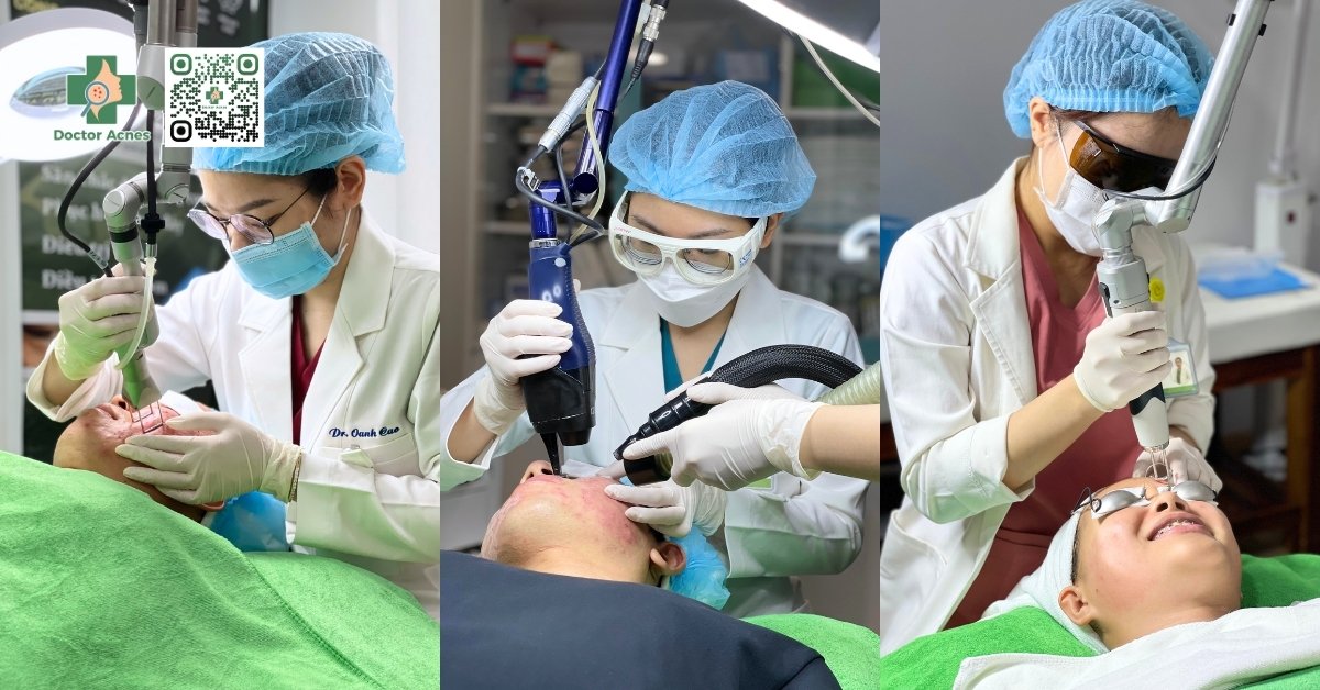 phương pháp laser điều trị sẹo rỗ