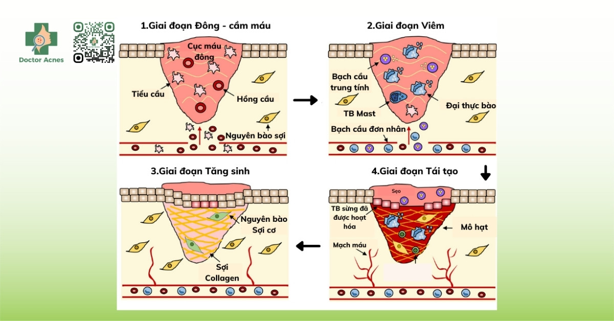 quá trình hình thành và lành lại của sẹo rỗ