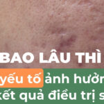 Sẹo bao lâu thì mờ? 4 yếu tố ảnh hưởng đến kết quả điều trị sẹo rỗ