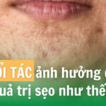 Tuổi tác ảnh hưởng đến kết quả trị sẹo như thế nào?