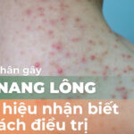 Nguyên nhân gây viêm nang lông, dấu hiệu nhận biết và cách điều trị
