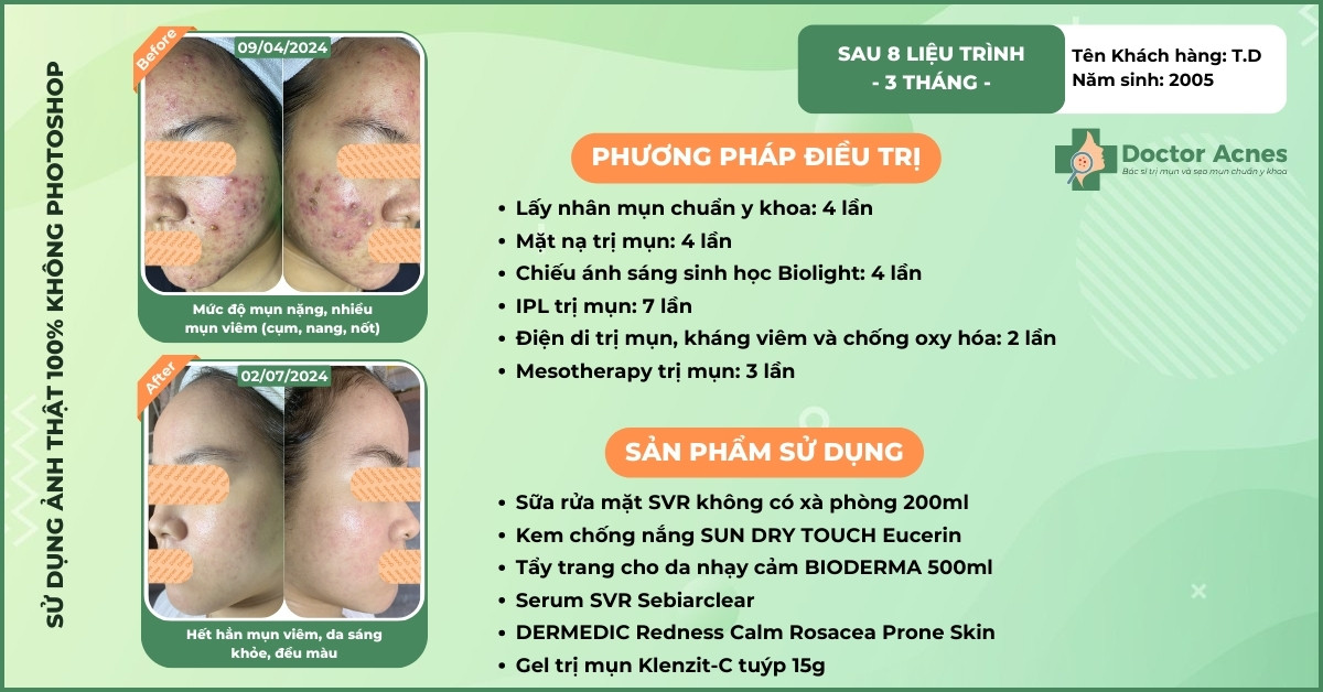 ca lâm sàng trị mụn