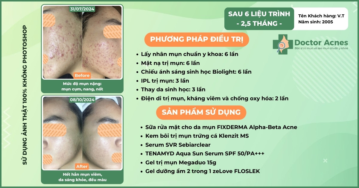 ca lâm sàng trị mụn