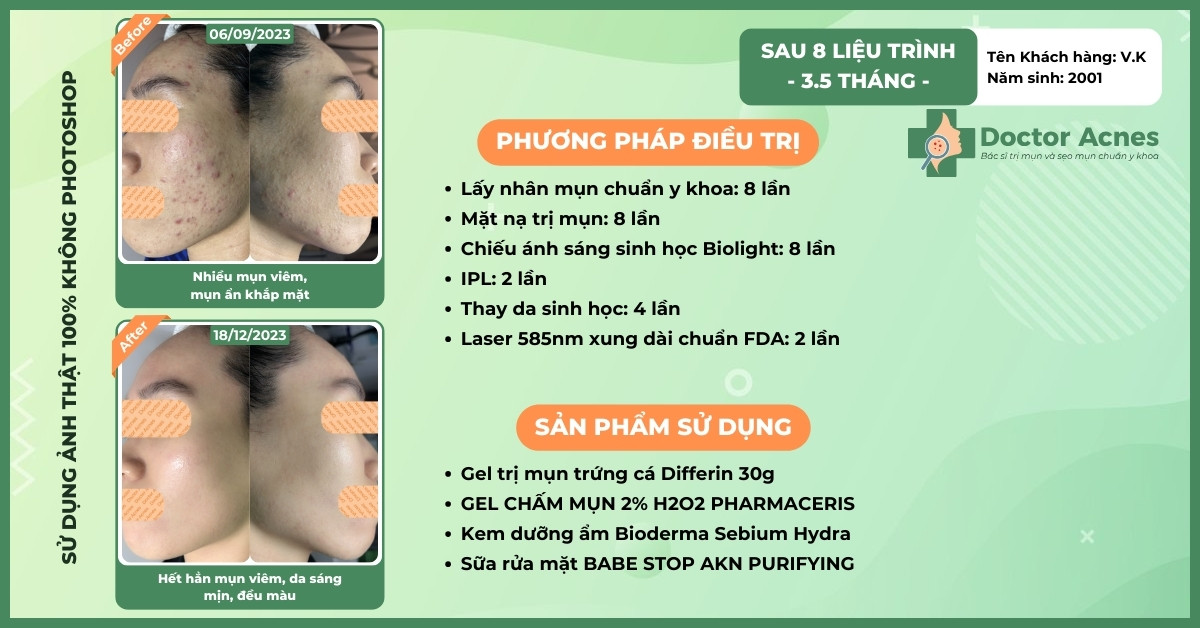 ca lâm sàng trị mụn