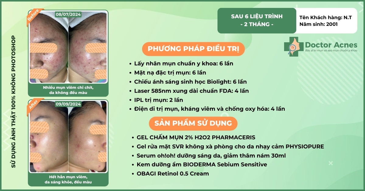 ca lâm sàng trị mụn